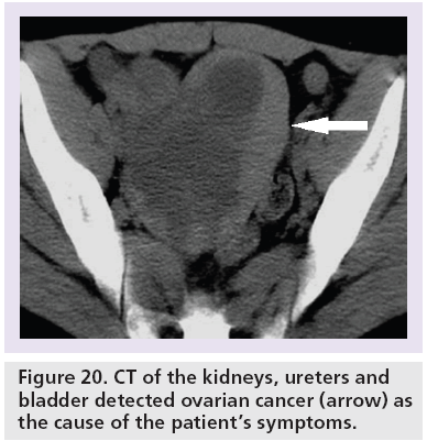 imaging-in-medicine-ovarian-cancer