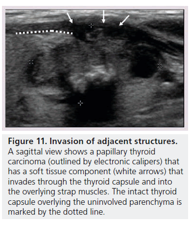 imaging-in-medicine-papillary–thyroid