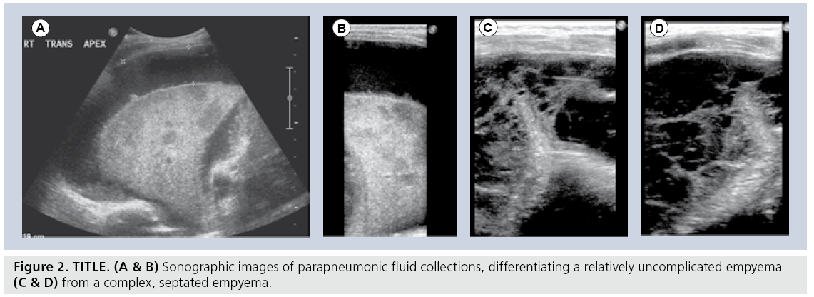 imaging-in-medicine-parapneumonic