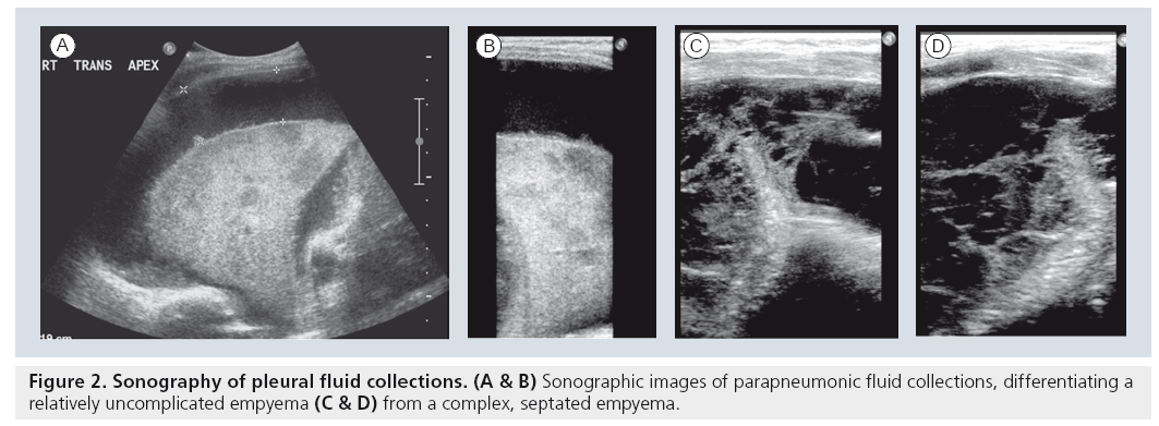 imaging-in-medicine-parapneumonic-fluid