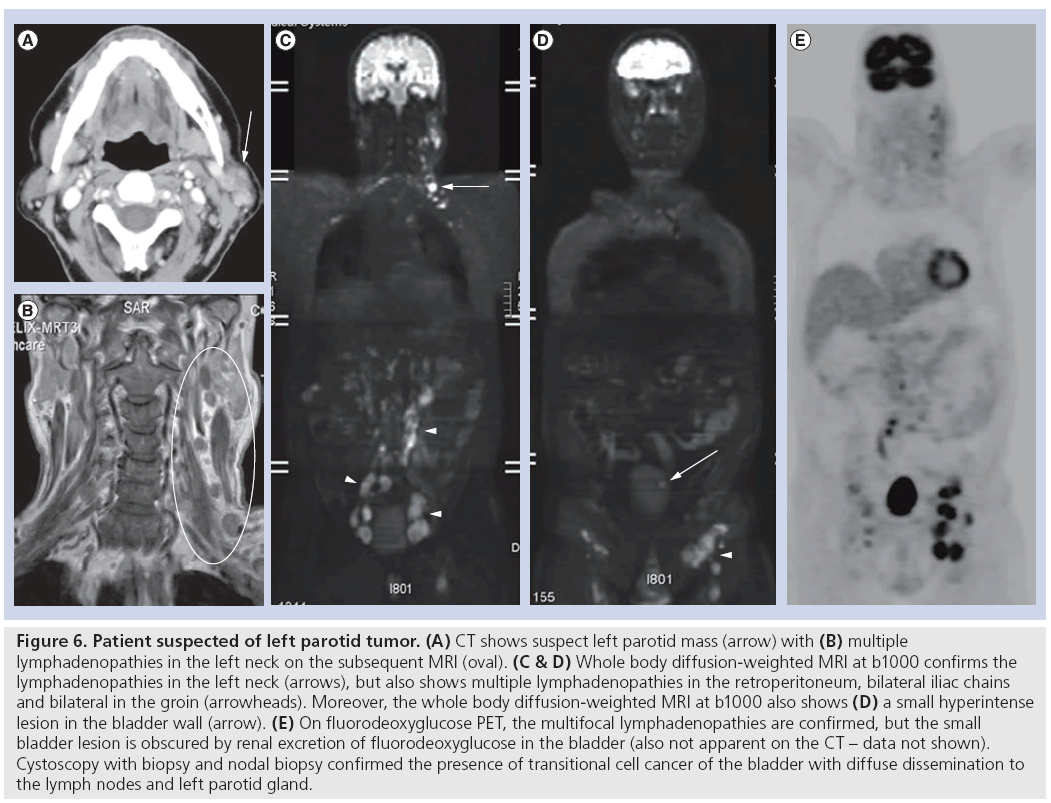 imaging-in-medicine-parotid-tumor