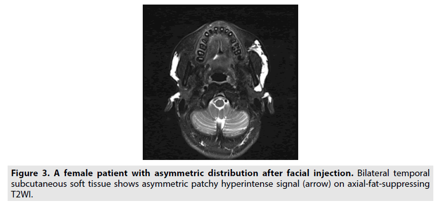 imaging-in-medicine-patchy-hyperintense