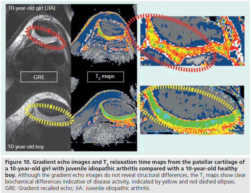 imaging-in-medicine-patellar-cartilage