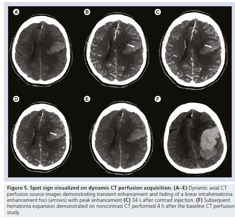 Advances In Ct For Prediction Of Hematoma Expansion In Acute Intracerebral Hemorrhage