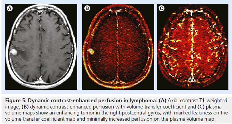 imaging-in-medicine-perfusion-lymphoma