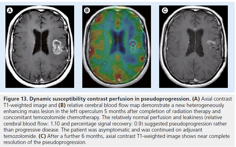 imaging-in-medicine-perfusion-pseudoprogression