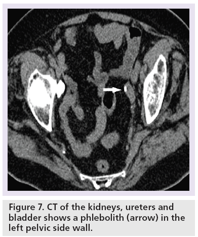 imaging-in-medicine-phlebolith
