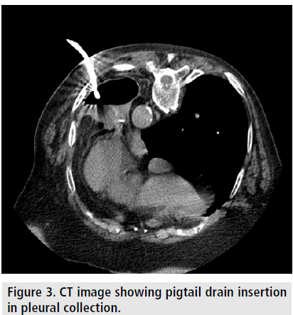 imaging-in-medicine-pigtail-drain