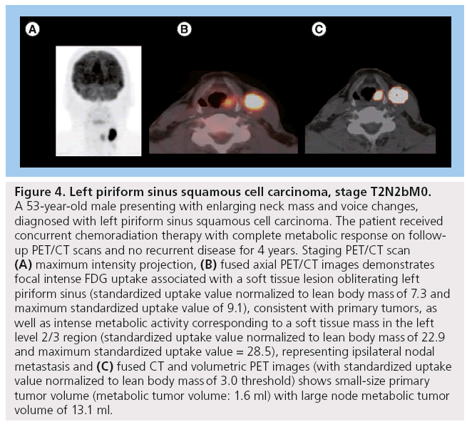 imaging-in-medicine-piriform-sinus