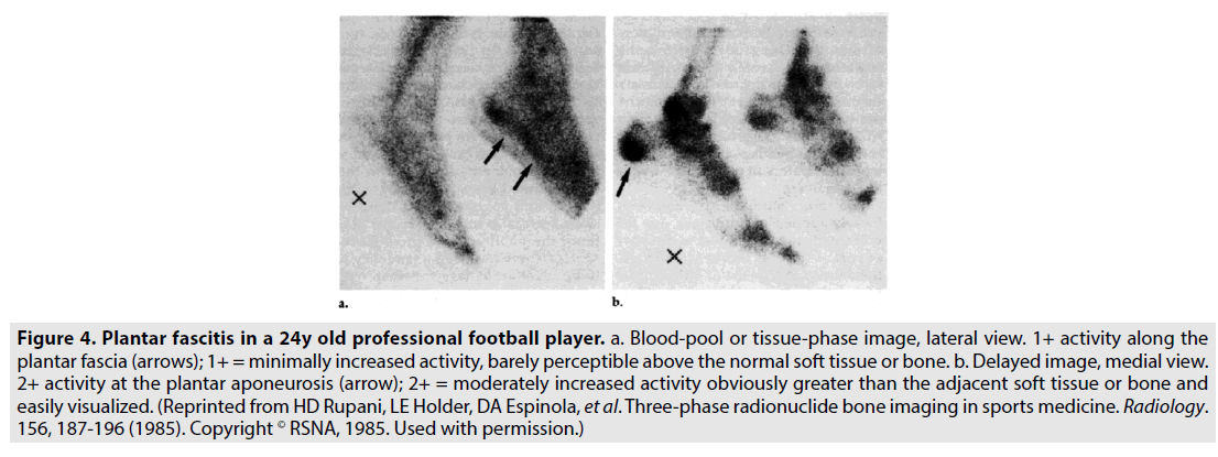 imaging-in-medicine-plantar-fascitis