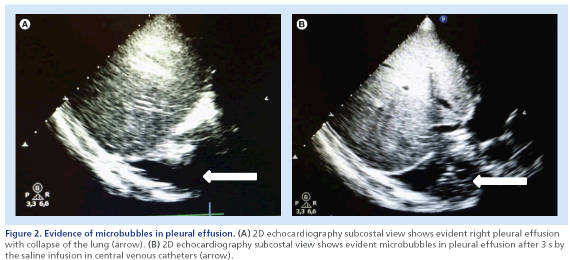 imaging-in-medicine-pleural-effusion