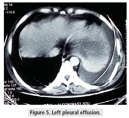 imaging-in-medicine-pleural-effusion
