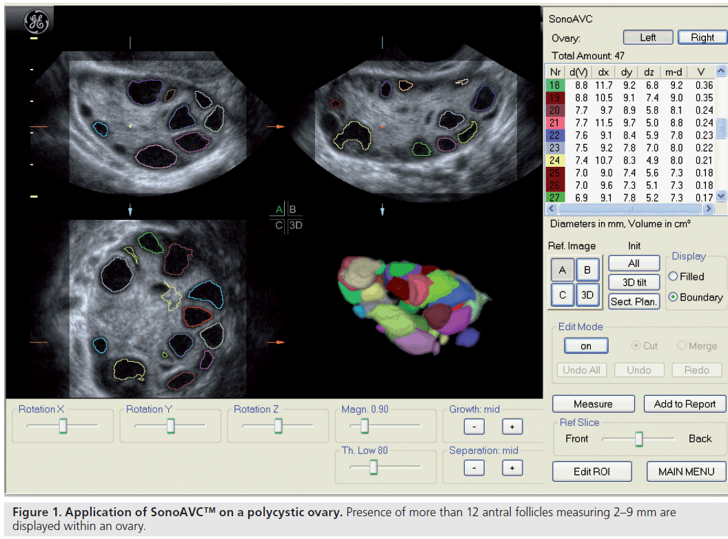 imaging-in-medicine-polycystic-ovary
