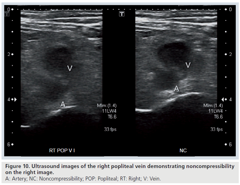 imaging-in-medicine-popliteal-vein