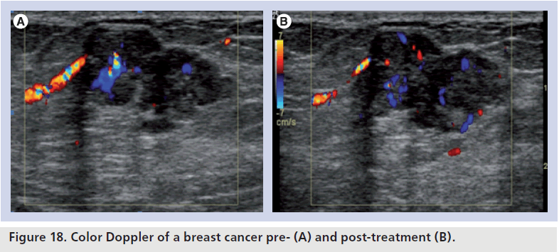 Doppler Ultrasound Color Chart