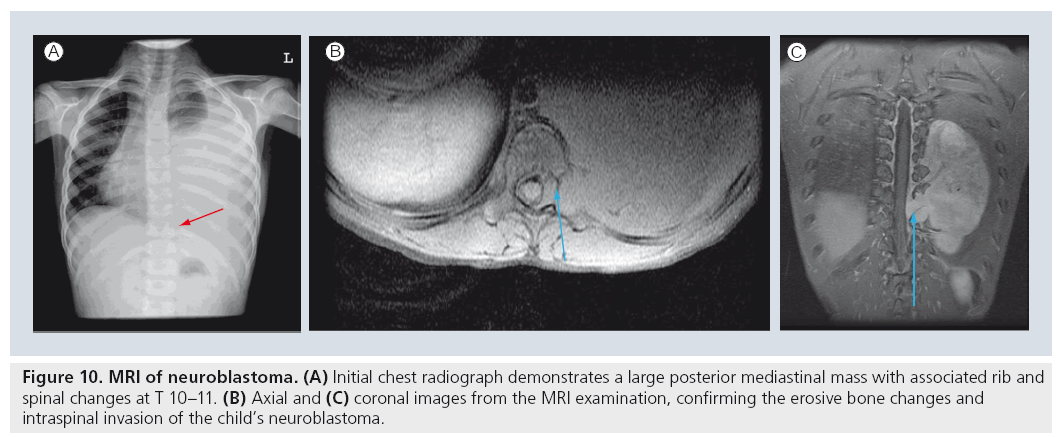 imaging-in-medicine-posterior-mediastinal