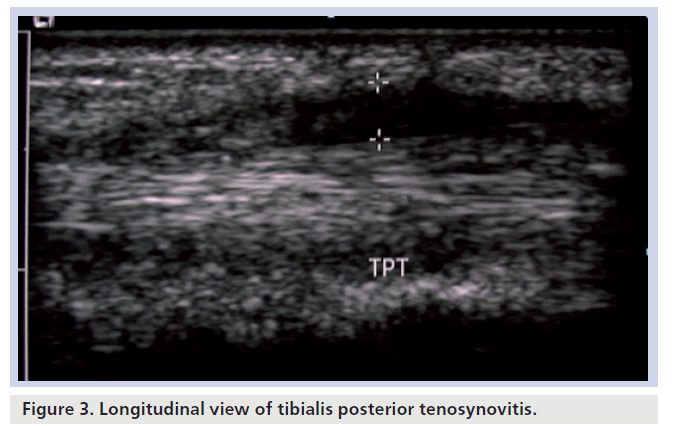 imaging-in-medicine-posterior-tenosynovitis