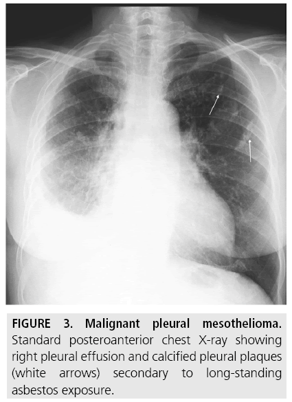 rate of mesothelioma cancer