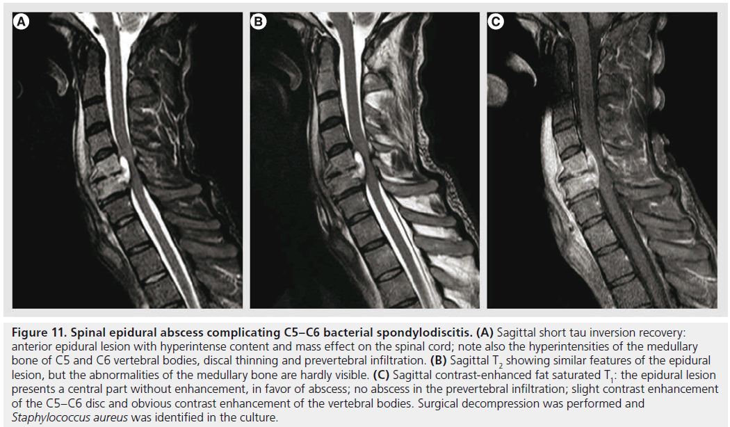 imaging-in-medicine-prevertebral-infiltration