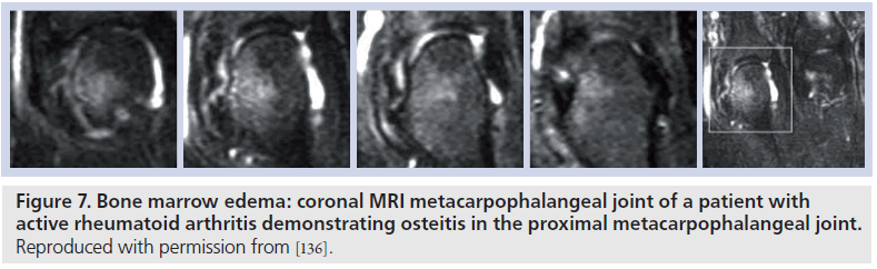 imaging-in-medicine-proximal-metacarpophalangeal