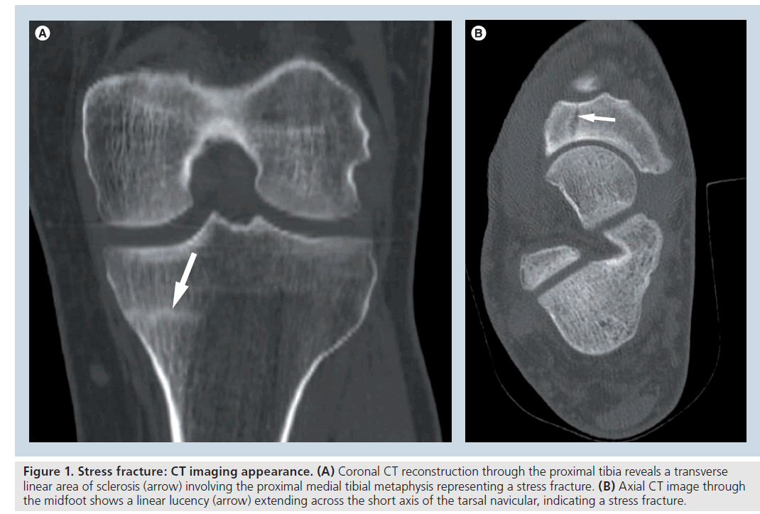 imaging-in-medicine-proximal-tibia