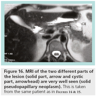 imaging-in-medicine-pseudopapillary-neoplasm