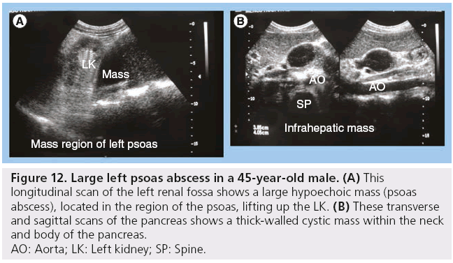 imaging-in-medicine-psoas-abscess