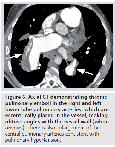 imaging-in-medicine-pulmonary-arteries