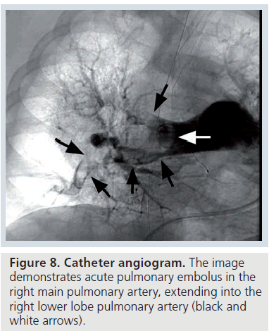 imaging-in-medicine-pulmonary-embolus