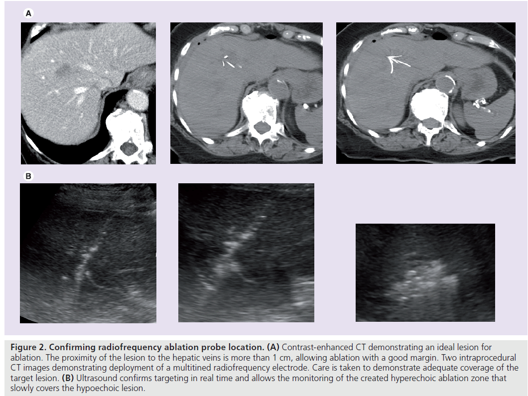 imaging-in-medicine-radiofrequency-electrode