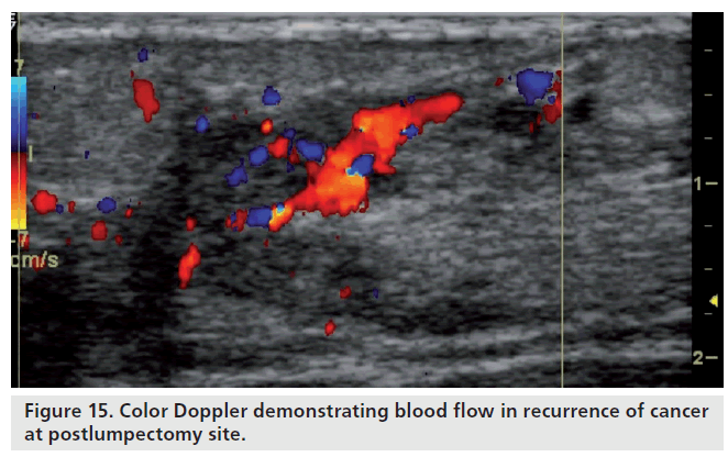 Confirm Diagnostic Ultrasound Of The Breast Can