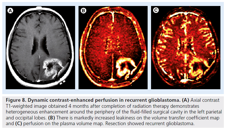 imaging-in-medicine-recurrent-glioblastoma