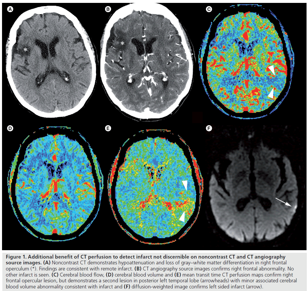 imaging-in-medicine-remote-infarct