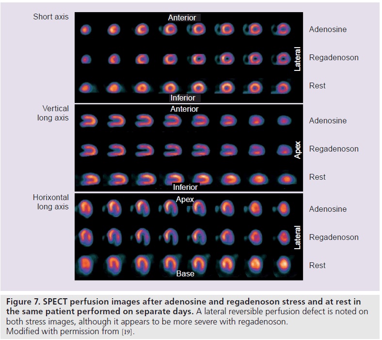 imaging-in-medicine-reversible-perfusion