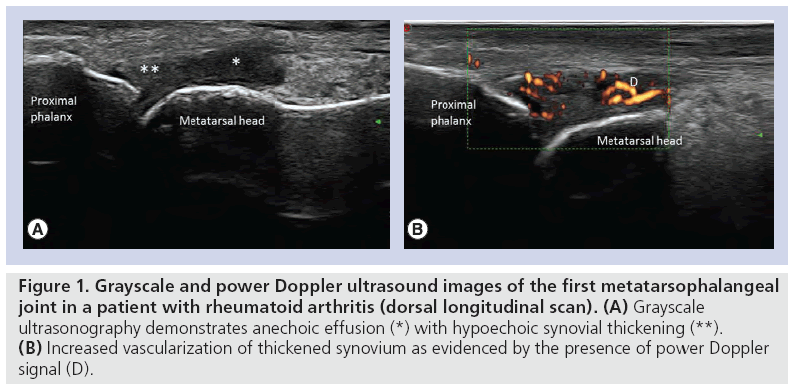 imaging-in-medicine-rheumatoid-arthritis