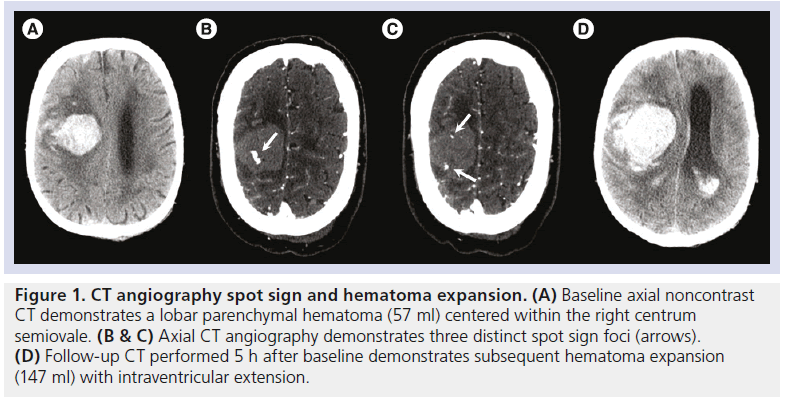 Advances In Ct For Prediction Of Hematoma Expansion In Acute Intracerebral Hemorrhage