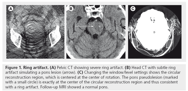 imaging-in-medicine-ring-artifact