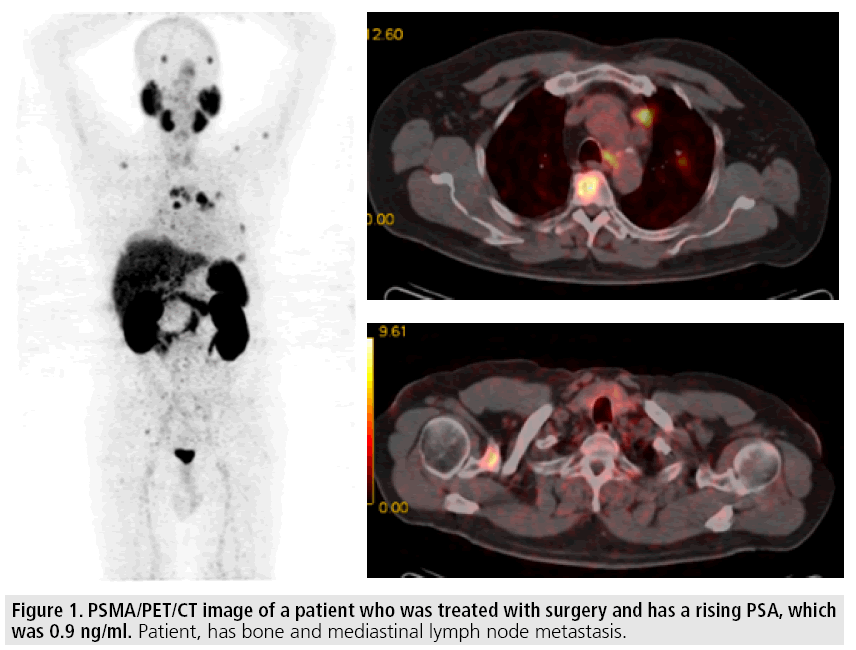 imaging-in-medicine-rising-PSA