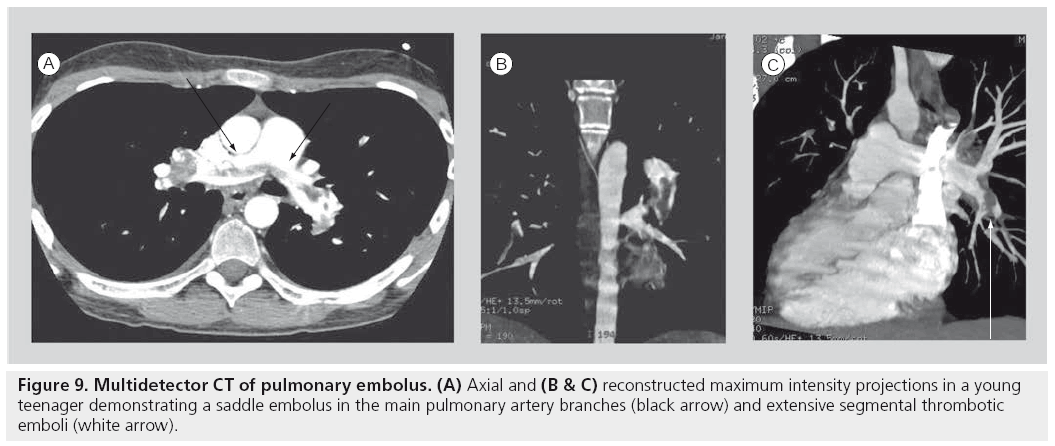 imaging-in-medicine-segmental-thrombotic