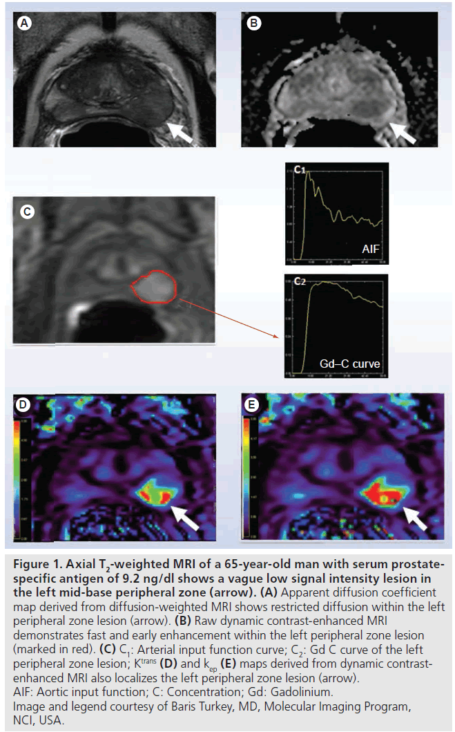 imaging-in-medicine-serum-prostatespecific