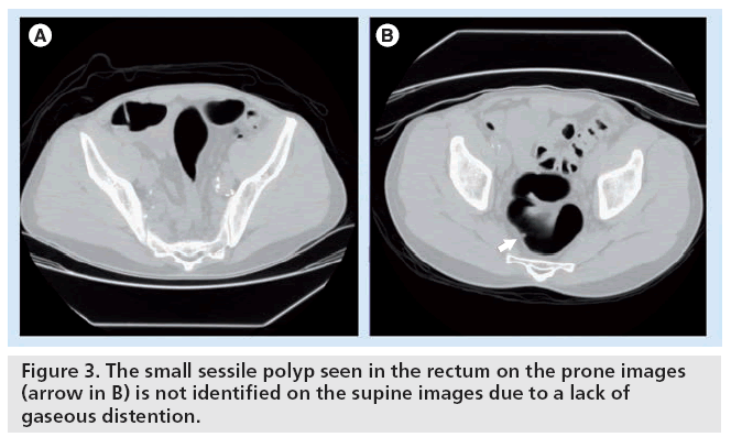 imaging-in-medicine-sessile-polyp