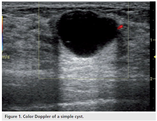 imaging-in-medicine-simple-cyst