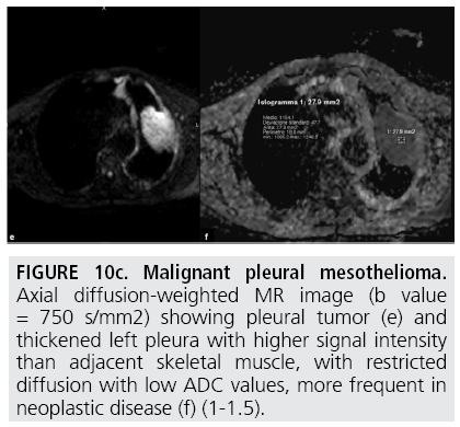 pelvic mesothelioma treatment