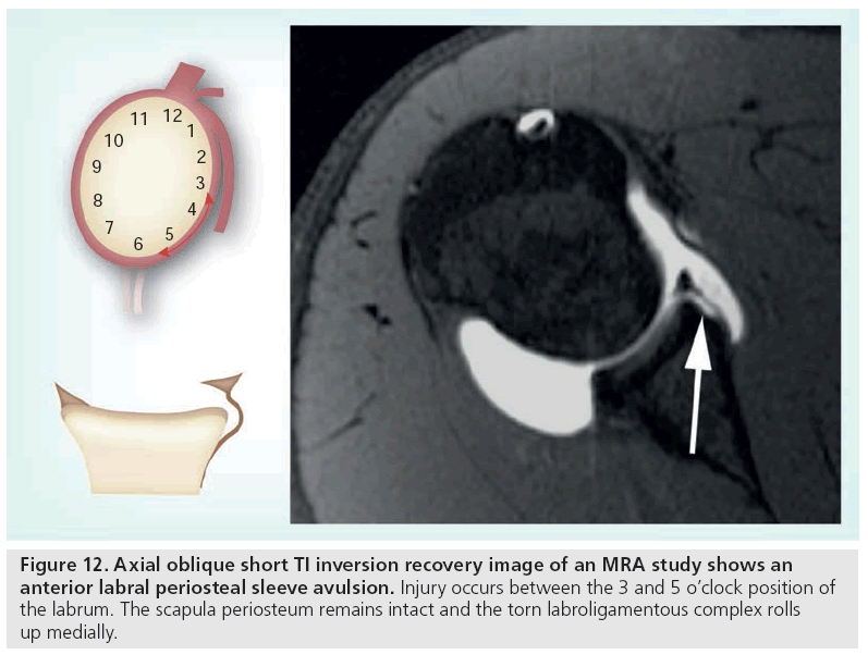 imaging-in-medicine-sleeve-avulsion