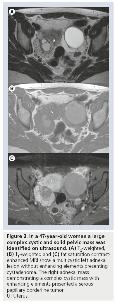 imaging-in-medicine-solid-pelvic-mass