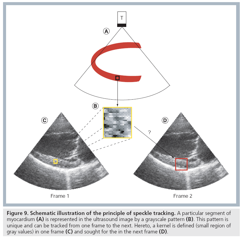 Strain Echocardiography part II: General concept 