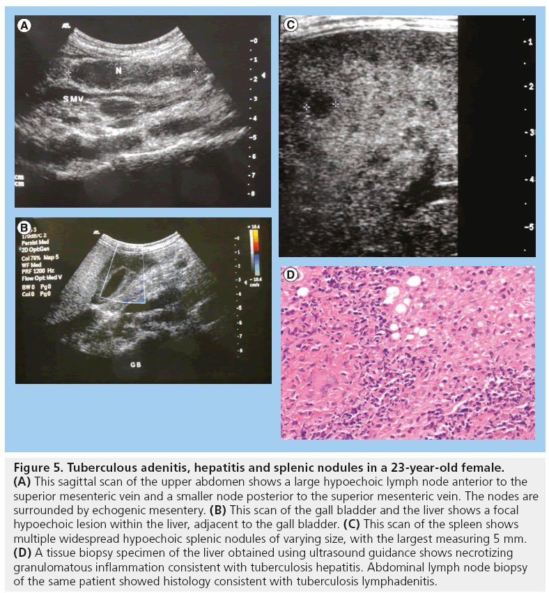 imaging-in-medicine-splenic-nodules