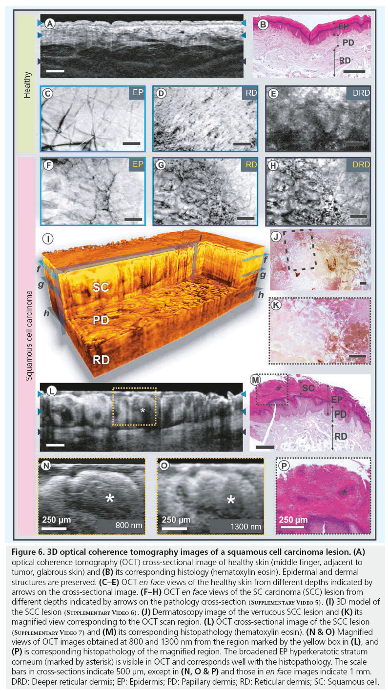 imaging-in-medicine-squamous-cell