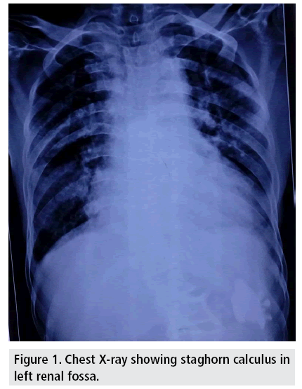 imaging-in-medicine-staghorn-calculus