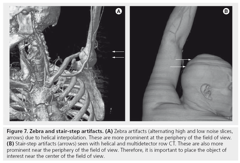 imaging-in-medicine-stair-step